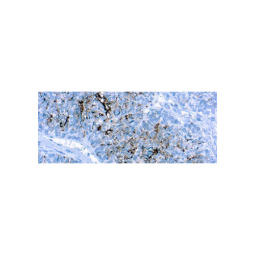 CA125