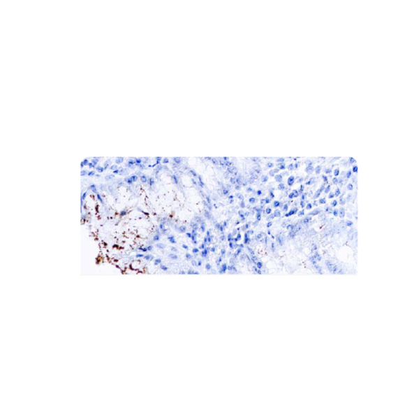Helicobacter pylori