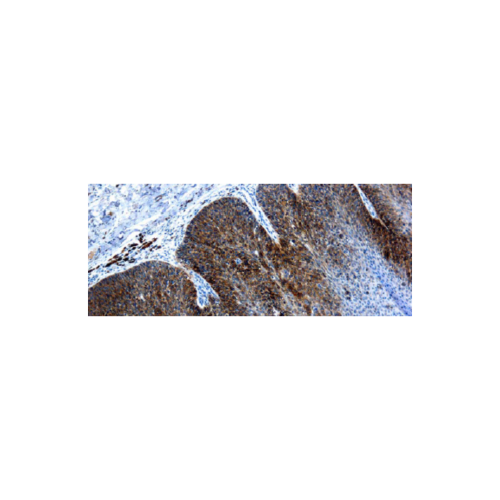 Virus del papiloma humano tipo 16, VPH 16