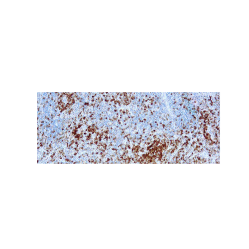 Anaplastic Lymphoma Kinase p80
