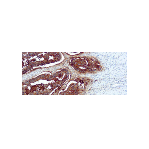Antigeno Carcinoembrion