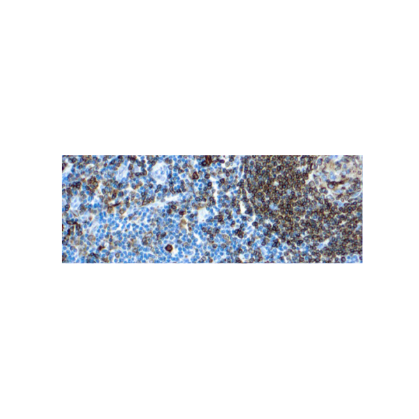 CD74, Marcador de linfoides