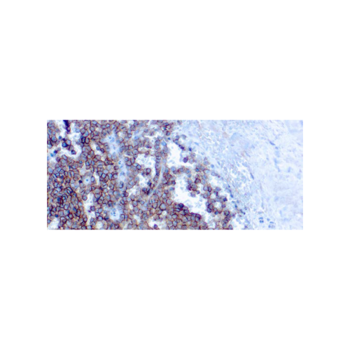 CD99MIC2, Ewing´s Sarcoma Marker