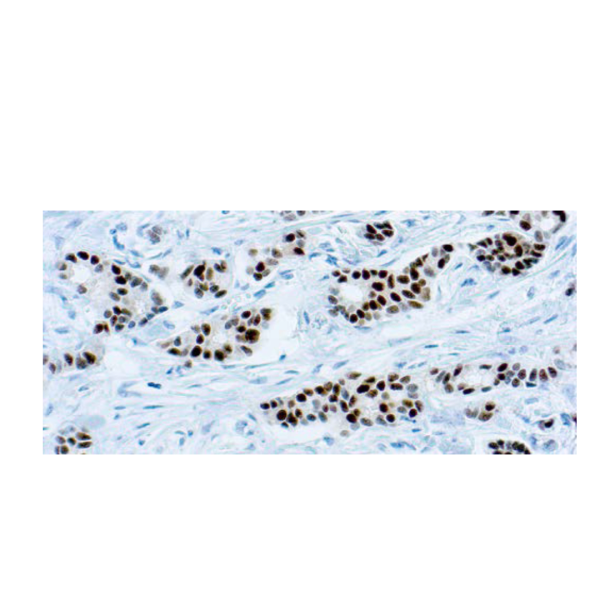 Estrogen Receptor (6F11) Estrogen Receptor (6F11)