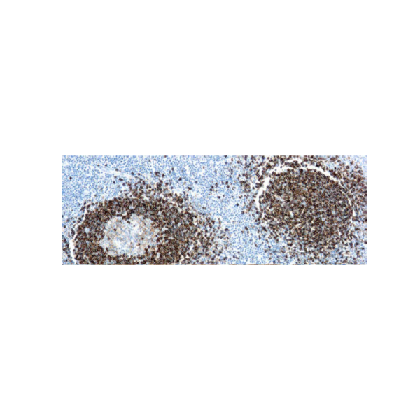 Leucemia de células peludas