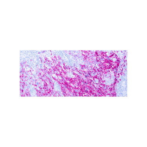 Melanoma (PNL2)