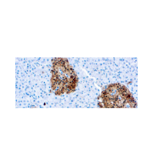Neurona Especifica Enolasa (NSE)