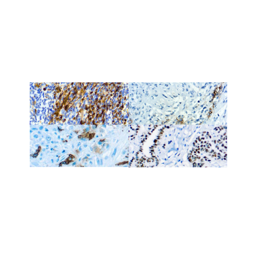 Panel Mesotelioma