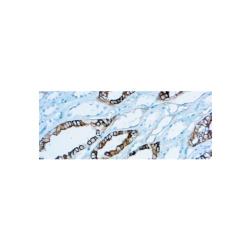 Renal Cell Carcinoma (gp200)