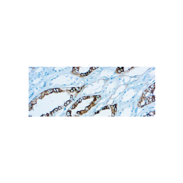 Renal Cell Carcinoma (gp200)