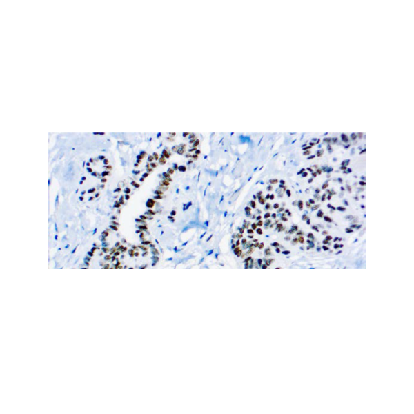 Wilm’s Tumor 1, WT1